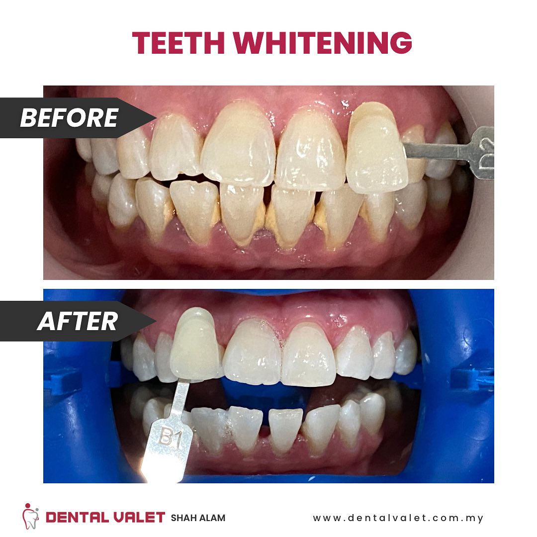dental valet klinik pakar gigi kanak kanak dan pesakit keperluan khas bangi shah alam dan damansara Teeth whitening