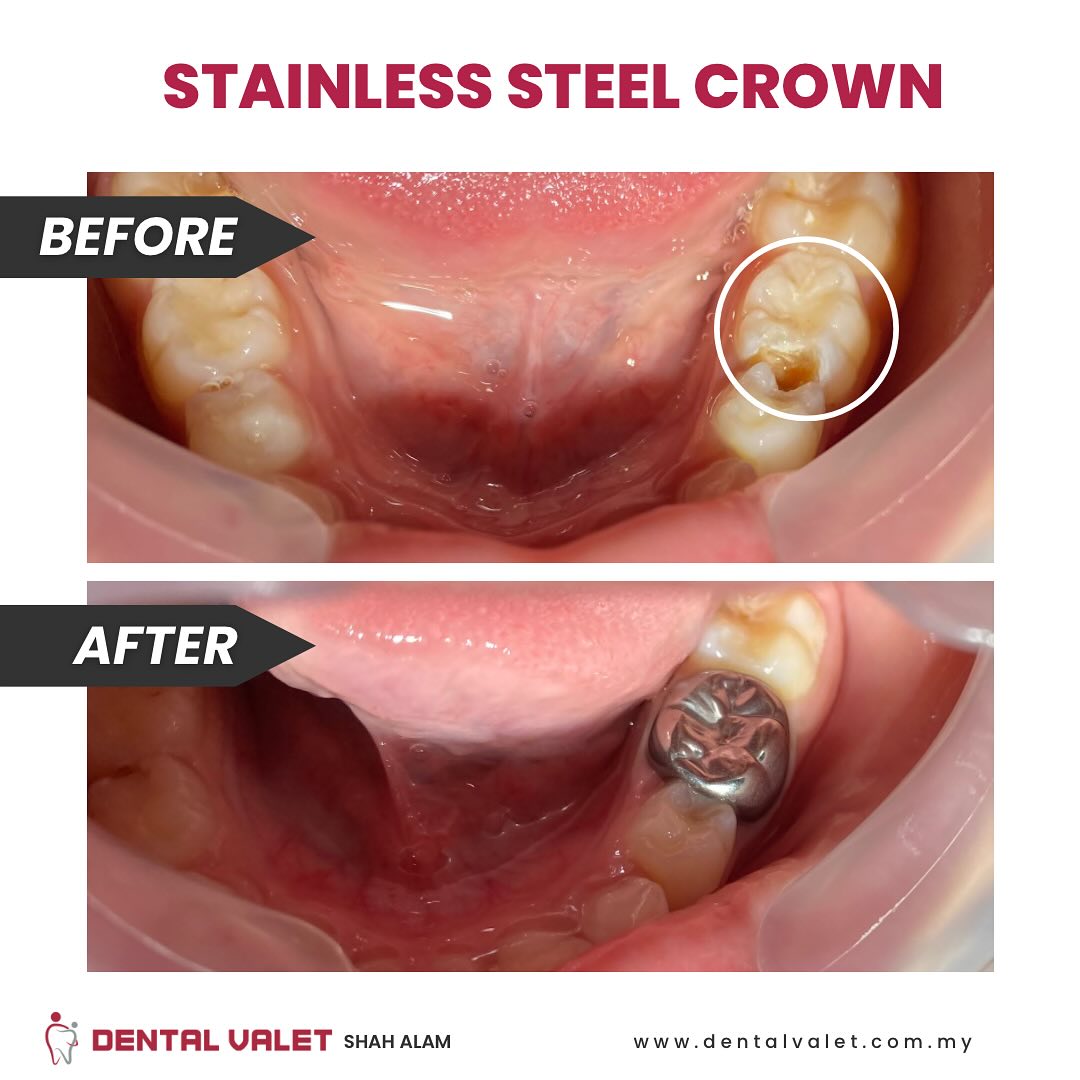 dental valet klinik pakar gigi kanak kanak dan pesakit keperluan khas bangi shah alam dan damansara stainless steel crown