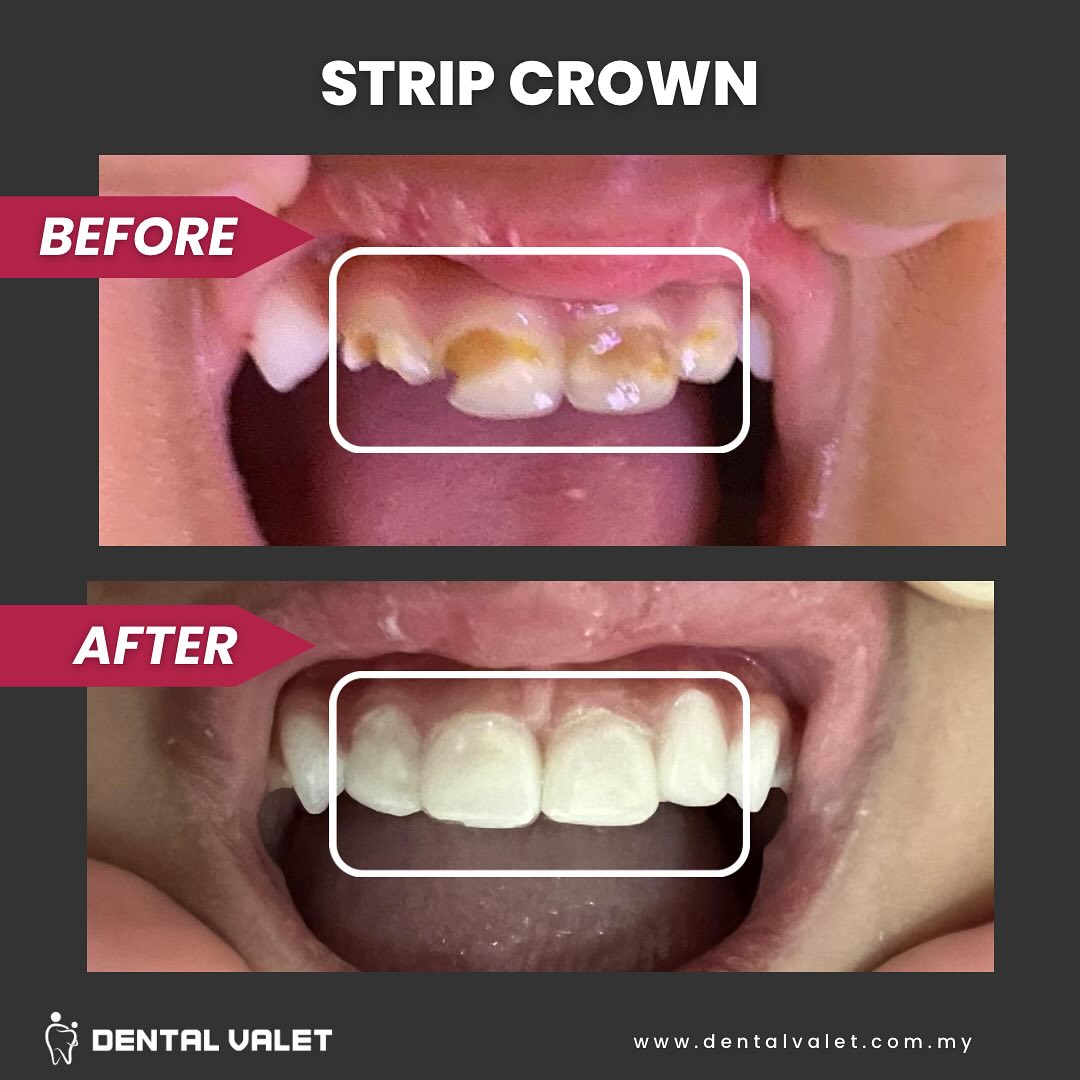 dental valet klinik pakar gigi kanak kanak dan pesakit keperluan khas bangi shah alam dan damansara strip crown