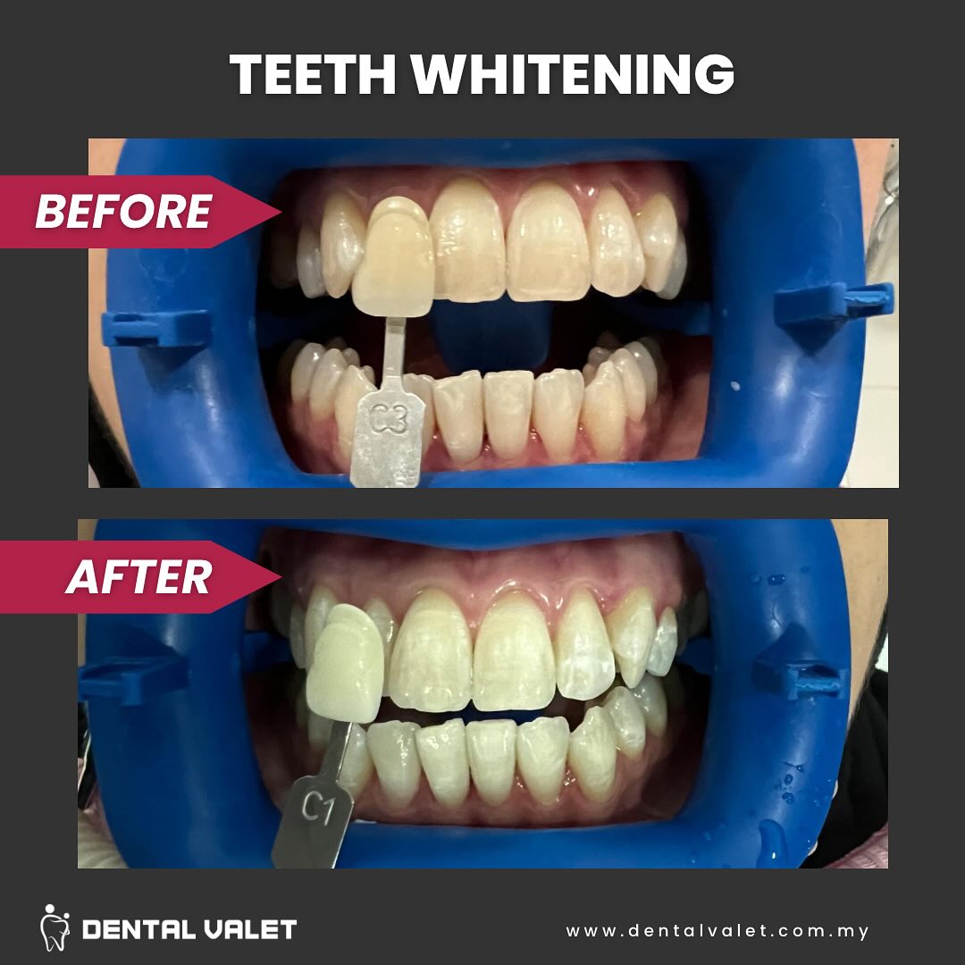 dental valet klinik pakar gigi kanak kanak dan pesakit keperluan khas bangi shah alam dan damansara teeth whitening 2