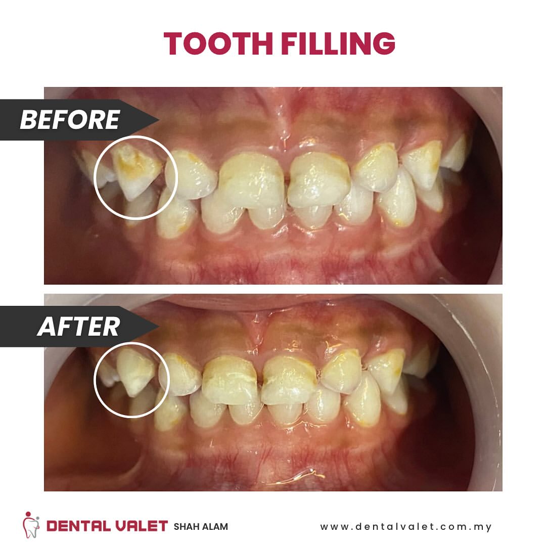 dental valet klinik pakar gigi kanak kanak dan pesakit keperluan khas bangi shah alam dan damansara tooth filling